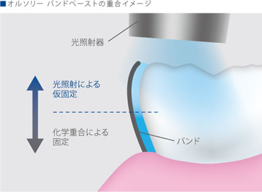 デュアルキュア型ペースト採用によりバンドの内面までしっかり重合