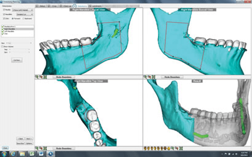 Osteotomy