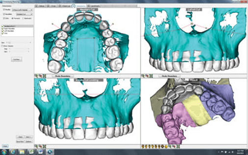 Osteotomy