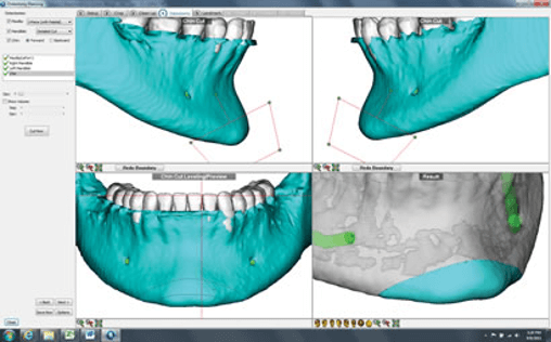 Osteotomy