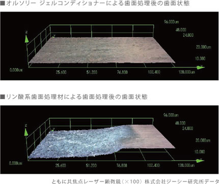 グラスアイオノマーならではのマイルドコンディショニング