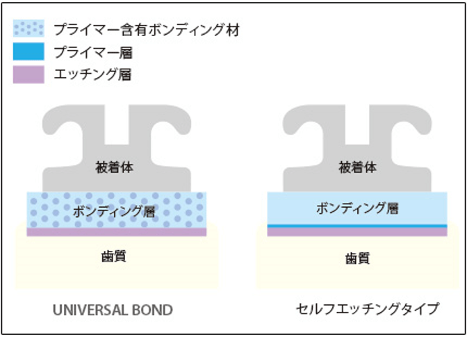 プライマー含有ペーストにより歯面とベース面に安定して接着