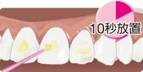 シンプルですばやい歯面処理01