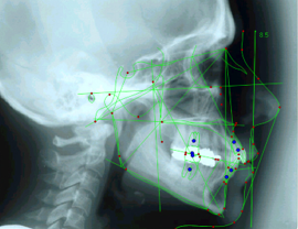 矯正・外科処置用：側貌セファロ分析