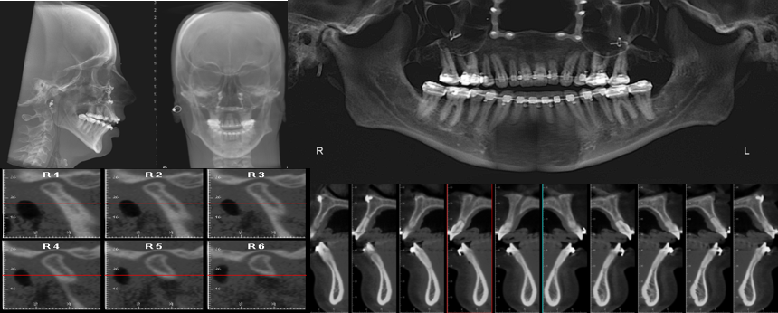 側面/正面セファロ、TMJ 断層　パノラマ、クロスセクション