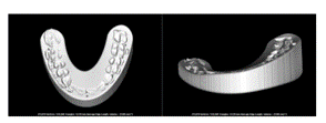 Osteotomy