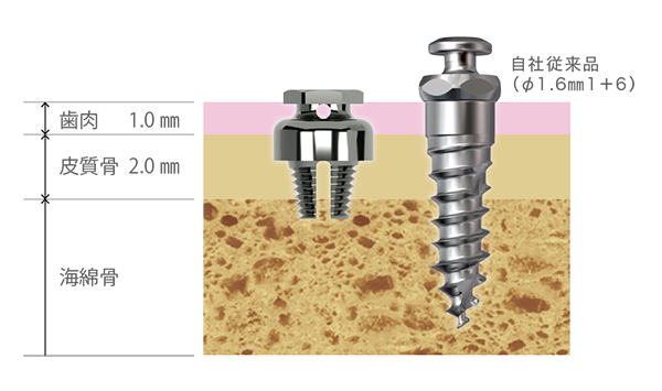 スクリュー長短縮による埋入ストレスの軽減